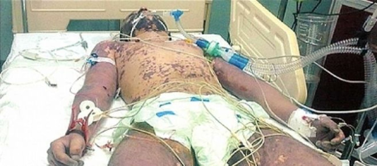 Silivri'de gizlenen hastalık