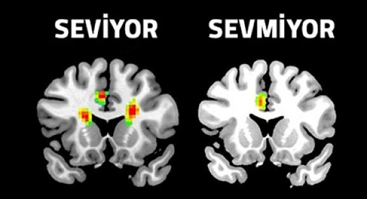 Aşkın MRını çektiler
