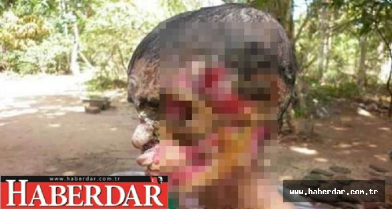 Et Yiyen Bakteri Türkiyede!