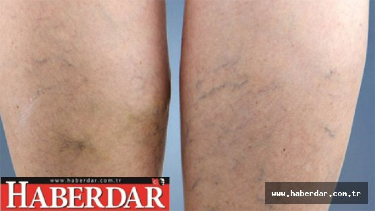 Güneşlenmek varis yapar mı?