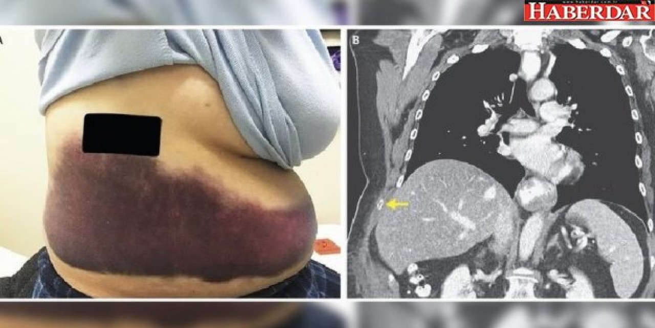 Grip olduktan sonra vücudu morarmaya başladı!