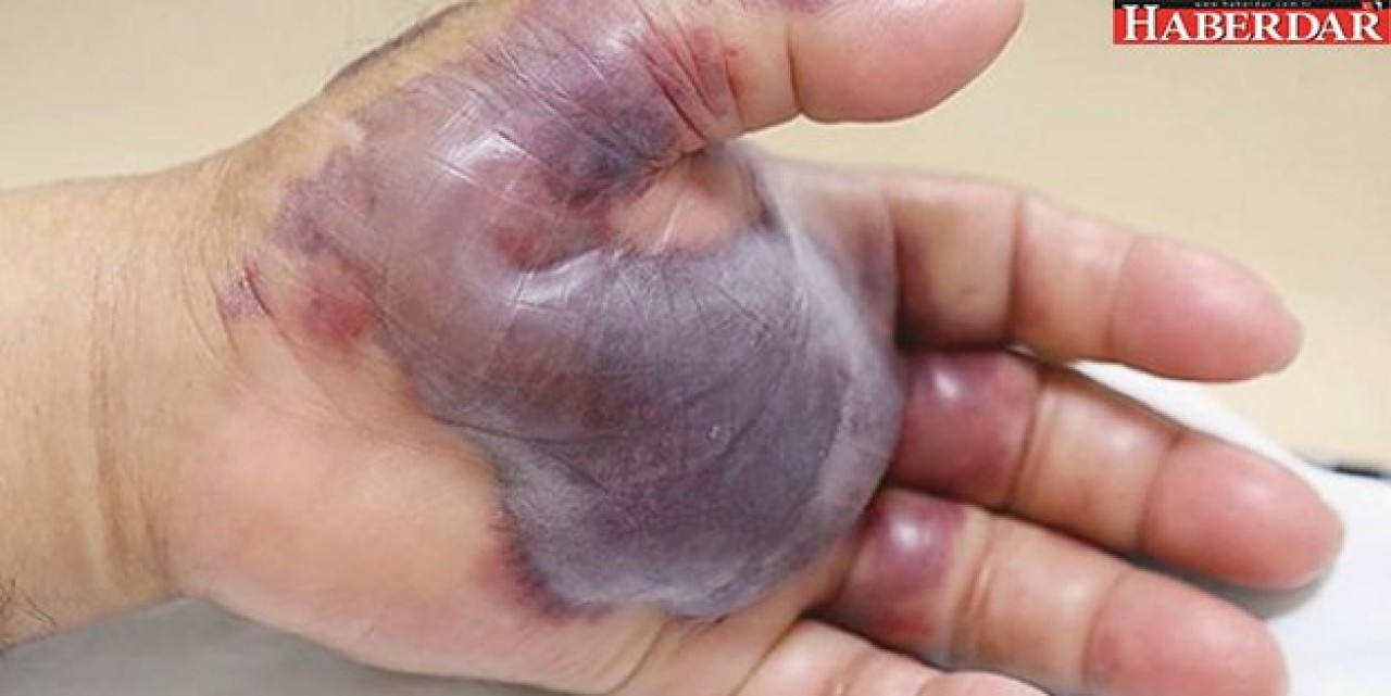 Çiğ et yedi, elinden oldu