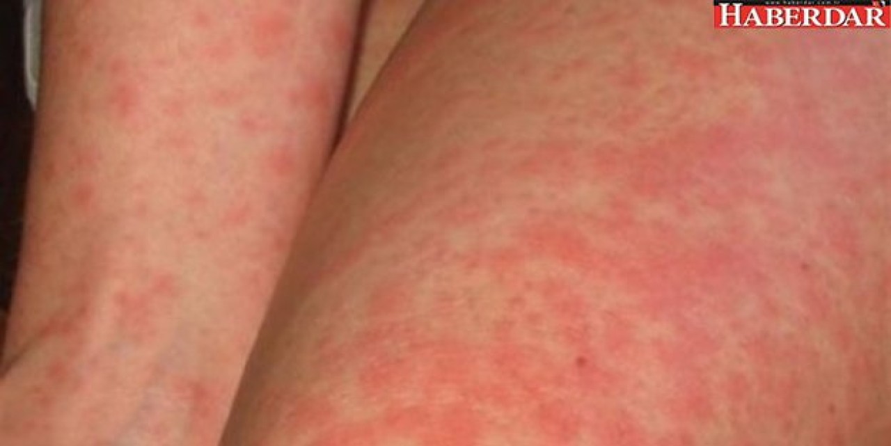 Bu hastalık AIDSten daha tehlikeli!