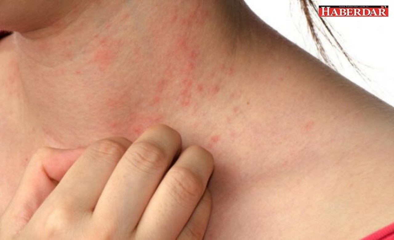 Uyuz vakalarında ilaç talebine yetişemiyoruz