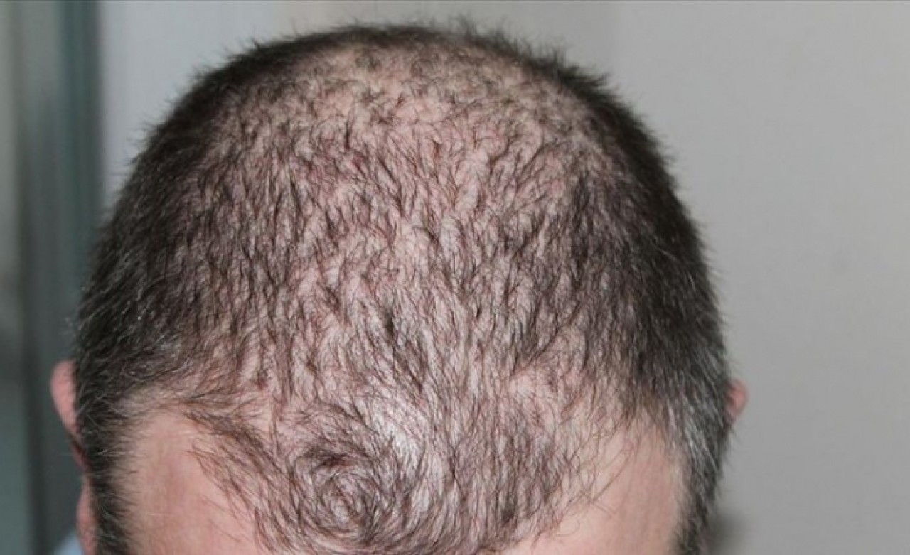 Koronavirüsü atlatanları bekleyen tehlike: Ciddi düzeyde saç dökülmesi olabilir