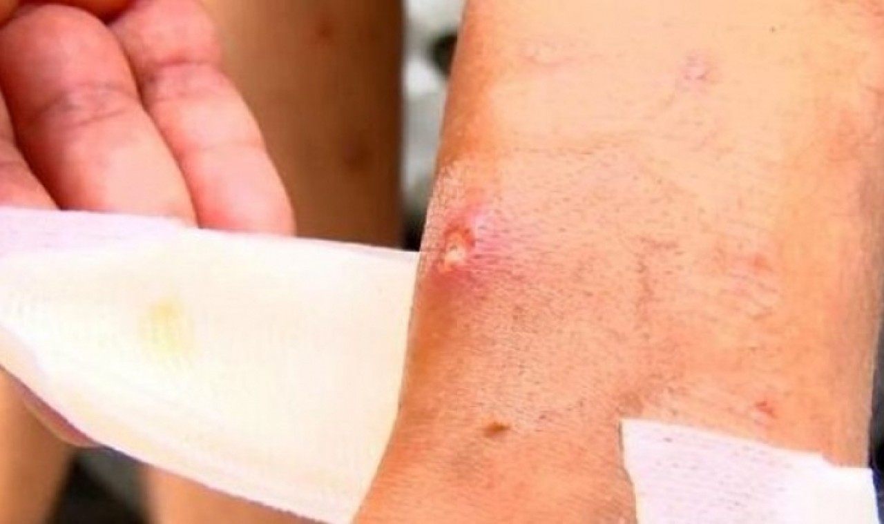 Avcılarda sivrisinek kabusu büyüyor