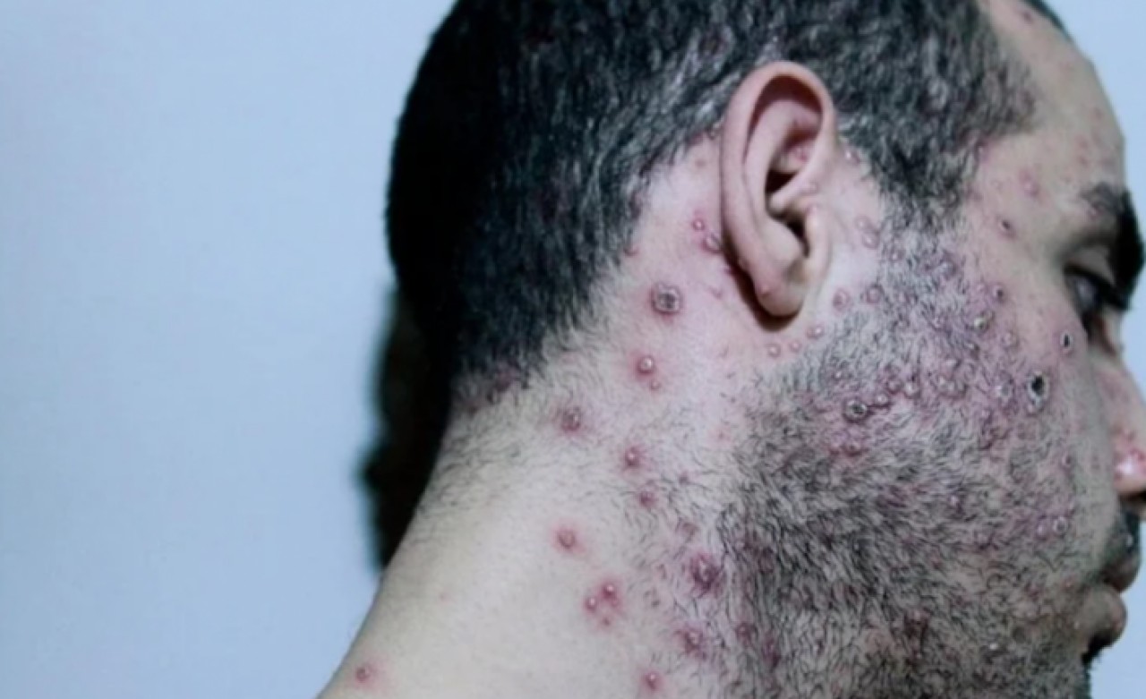 DSÖ’den maymun çiçeği salgını ile ilgili endişelendiren risk açıklaması