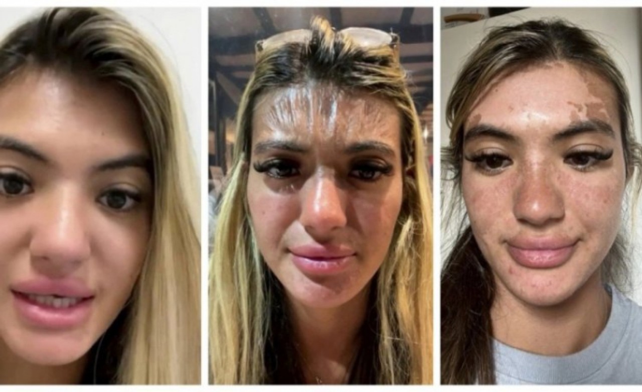 Güneşin altında uyuyakaldı, yüzü plastik gibi gerildi!