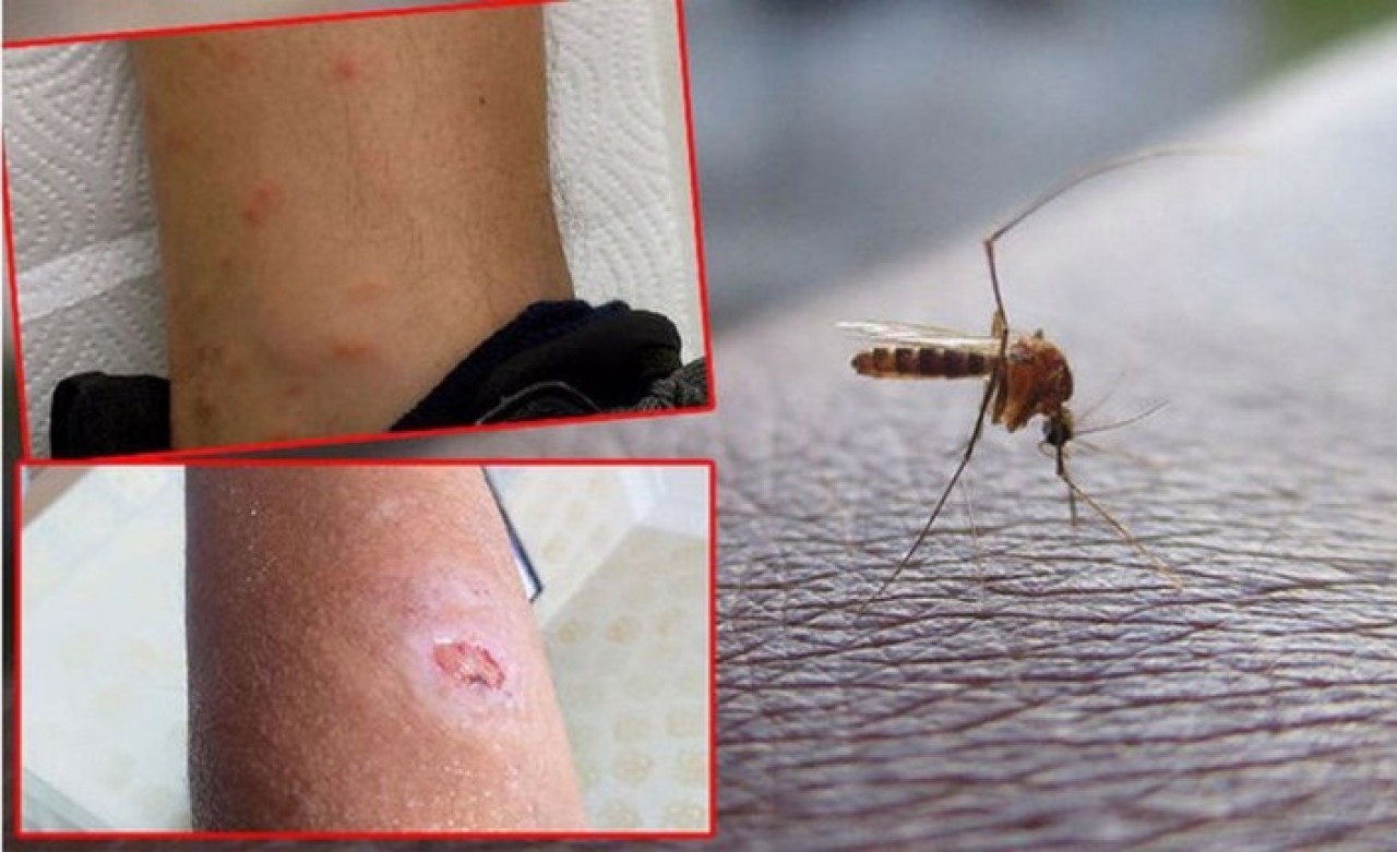 İstanbulda sivrisinek kabusu! Hastaneler dolup taştı, hedeflerinde iki kan grubu var