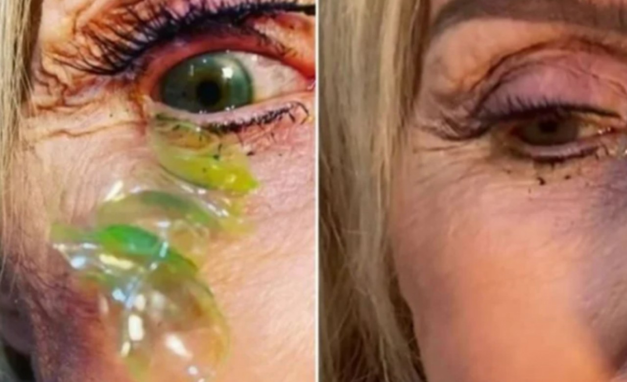 23 gün boyunca lenslerini çıkarmadan üzerine yeni lens taktı, hastanelik oldu!
