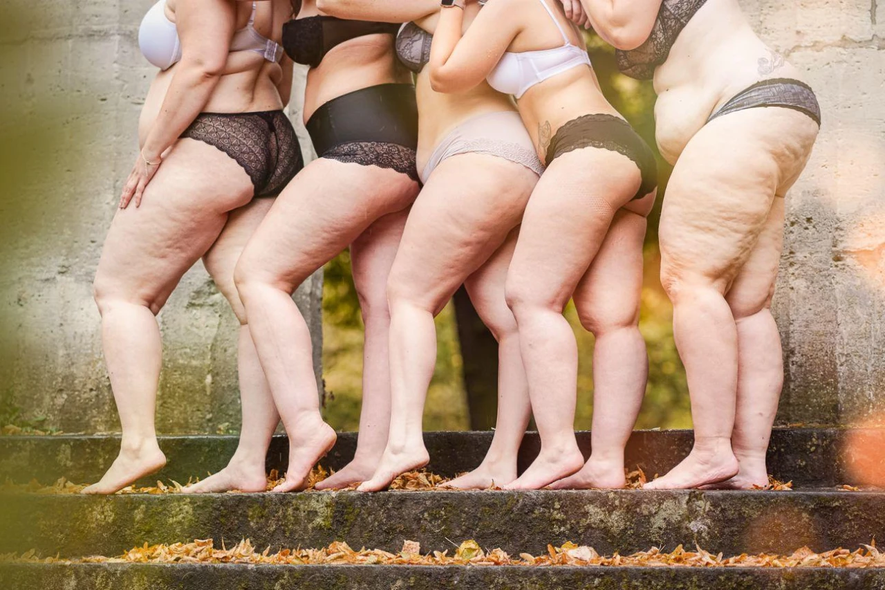 Lipödem varsa zayıflık yok!