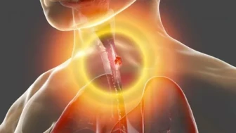 Yemek borusu kanserinin 6 belirtisine dikkat!