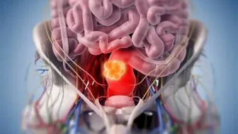 Kolorektal kanserlerin 5 nedenine dikkat!