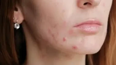 Akne oluşumuna yol açan 7 hata