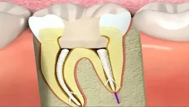 Kanal tedavisi dişin ömrünü uzatıyor!