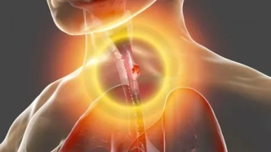 Yemek borusu kanserinin 6 belirtisine dikkat!