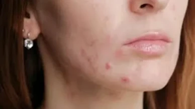 Akne oluşumuna yol açan 7 hata