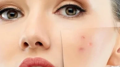 Güneşli Günler Gelmeden Önce Cilt Lekelerine Karşı Alınabilecek Önlemler