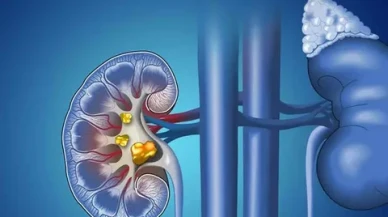 “Böbrek taşımı düşürdüm” diyenler dikkat!