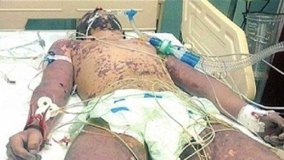 Silivri'de gizlenen hastalık