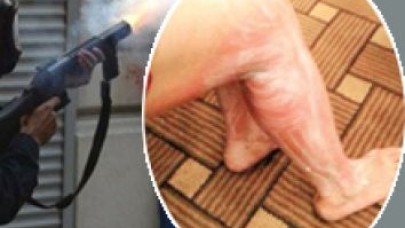 Direnişçiye buhar bombası