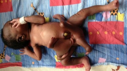 4 kol 4 bacak ile doğdu