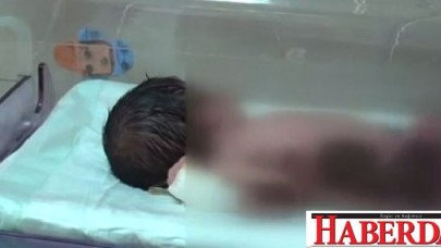 Yeni doğan bebeği ısıtıcıda unutup yaktılar!