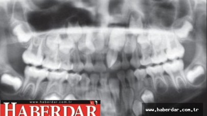 Adamın Ağzından 232 Tane Diş Çekildi!