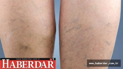 Güneşlenmek varis yapar mı?