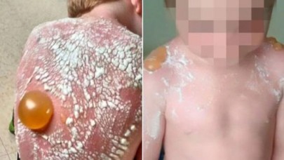 Öyle güneş yanığı görülmedi