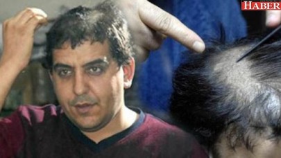 Düzleştirmek istediği saçlarını kaybetti!