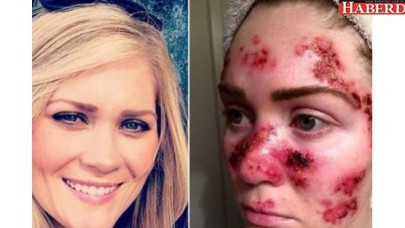 Solaryuma girmeden önce ve sonraki hali!