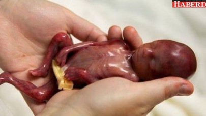 14 Haftalık Bebeğin Yaşamı Mahkeme Kararıyla Sonlandırıldı