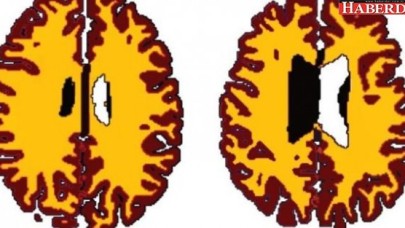 Aşırı kilo beyni yaşlandırıyor