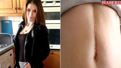 Karnından 1 Kilo 360 Gram Saç Çıktı