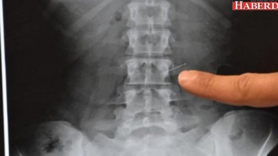 Ağzına aldığı toplu iğne, öksürünce...