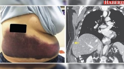 Grip olduktan sonra vücudu morarmaya başladı!