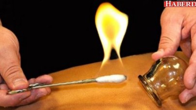 Sülük, hacamat, hipnoz SGK kapsamına alınıyor