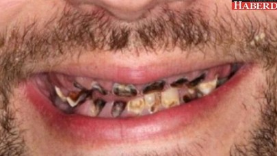 Bu bağımlılık tüm dişlerini paramparça etti!