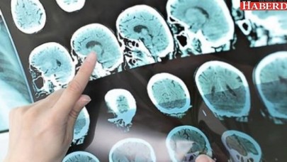Alzheimer hastalarına iyi haber