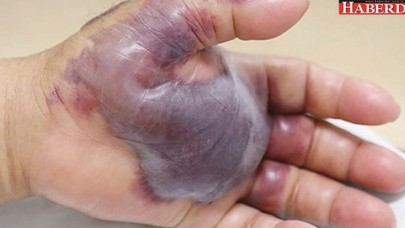 Çiğ et yedi, elinden oldu