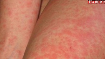 Bu hastalık AIDSten daha tehlikeli!