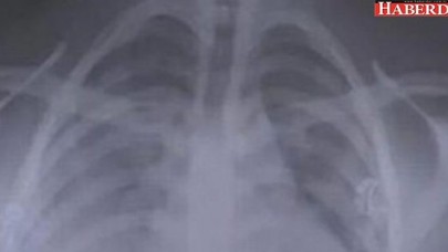 Korkunç tablo! Sadece 18 ay kullandı ve bu hale geldi