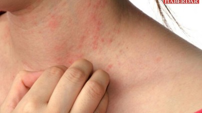 Uyuz vakalarında ilaç talebine yetişemiyoruz