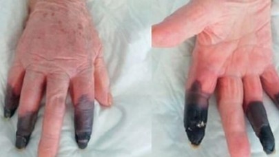 Koronavirüse yakalandıktan sonra kangren olan kadın, parmaklarını kaybetti