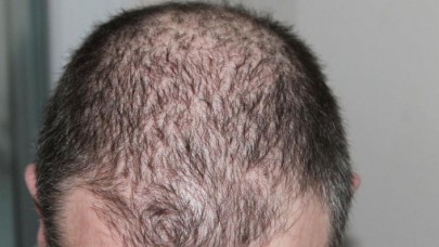 Koronavirüsü atlatanları bekleyen tehlike: Ciddi düzeyde saç dökülmesi olabilir