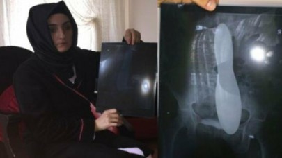 Kadın hastanın karnında unutulan mala için Sağlık Bakanlığı 82 bin lira tazminat ödeyecek