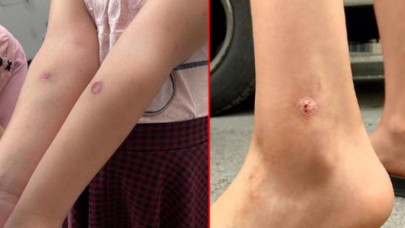Korona bitmeden İstanbulun göbeğinde yeni kabus! Sivrisineklerin soktuğu çocuklarda yaralar oluşmaya başladı