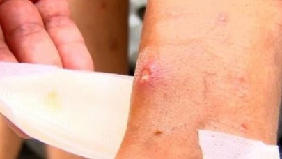 Avcılarda sivrisinek kabusu büyüyor