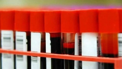 Kan grupları ile hastalıklar arasındaki bağlantı ortaya çıktı: Bu gruba gün doğdu!